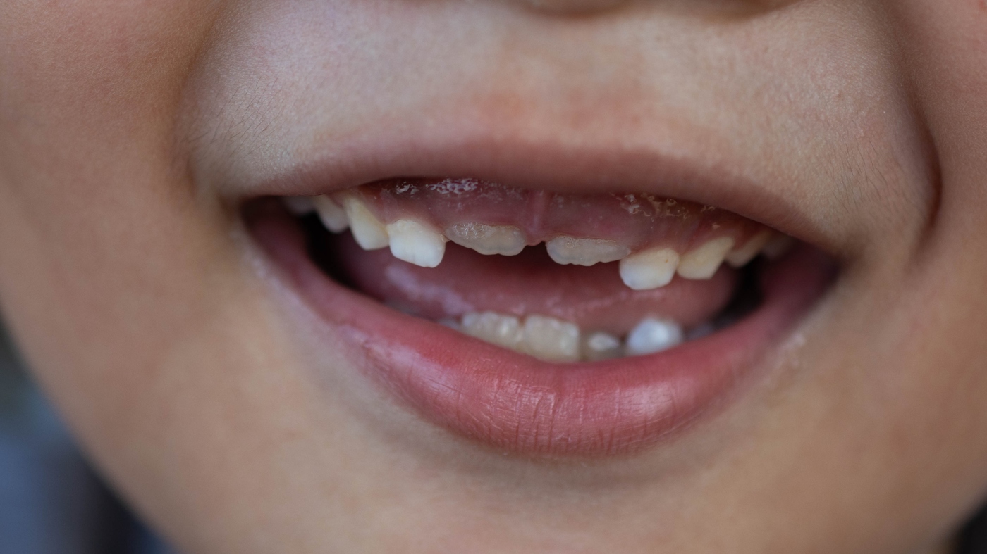 FDA strikes to ban fluoride dietary supplements for teenagers, eradicating a key instrument for dentists : Pictures